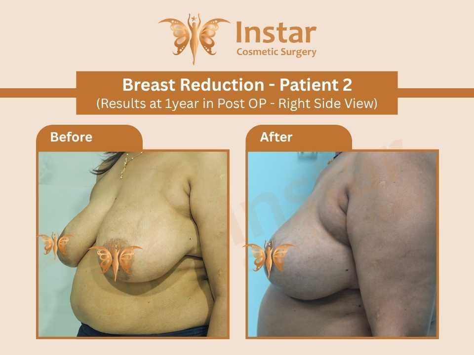 Breast Reduction ((Results at 1year in Post OP - Right Side View)